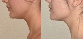 DrenaFace – Escova de Drenagem Linfática Facial