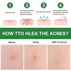 Adesivo para Acne Secativo e Clareador - 24 Peças