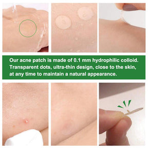 Adesivo para Acne Secativo e Clareador - 24 Peças
